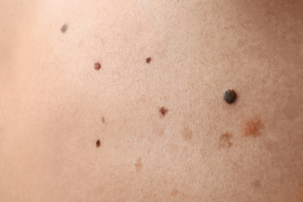 Mole Removal: What You Can Expect Before, During, and After   SELF