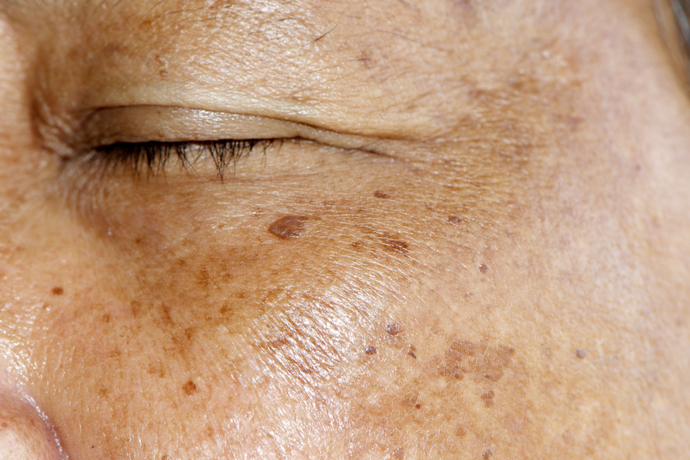 Laser Treatment for the Removal of Dark Spots