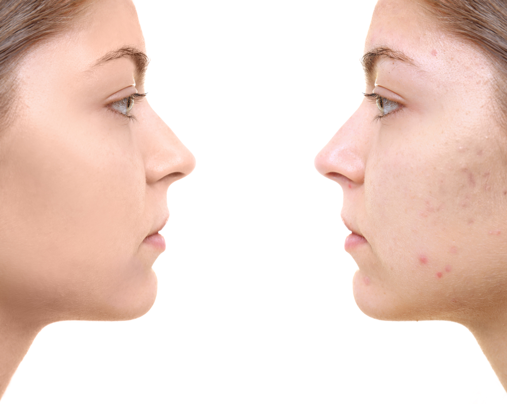acne treatment