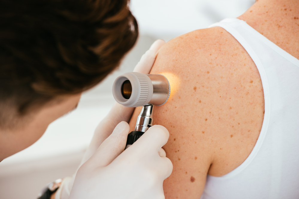 Signs of Melanoma